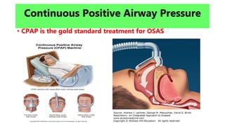 Continuous Positive Airway Pressure
• CPAP is the gold standard treatment for OSAS
 