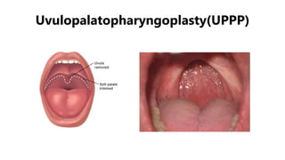 Uvulopalatopharyngoplasty(UPPP)
 