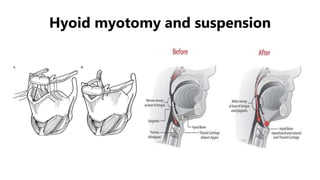 Hyoid myotomy and suspension
 