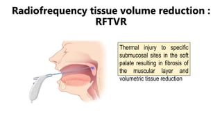 Radiofrequency tissue volume reduction :
RFTVR
Thermal injury to specific
submucosal sites in the soft
palate resulting in fibrosis of
the muscular layer and
volumetric tissue reduction
 