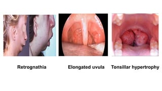 Retrognathia Elongated uvula Tonsillar hypertrophy
 