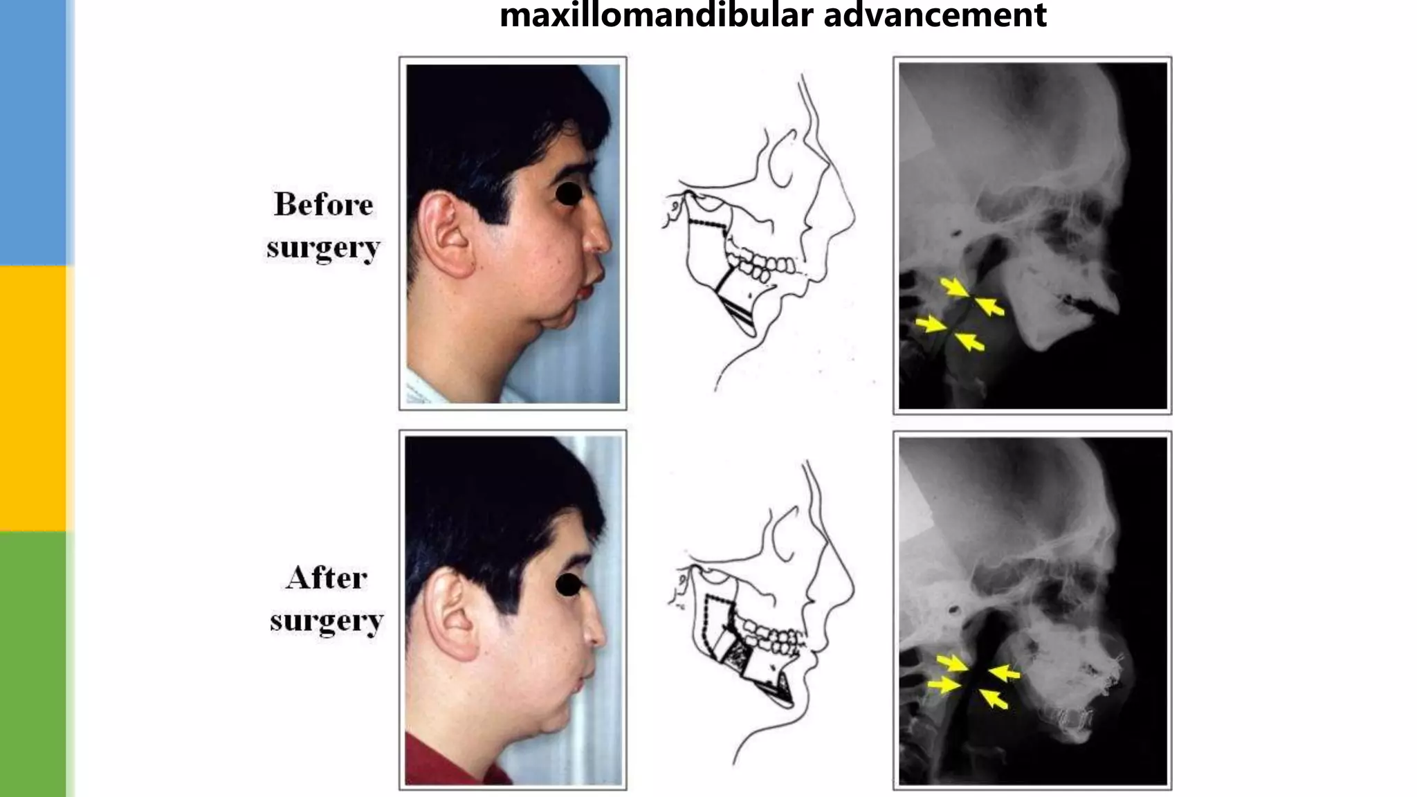 maxillomandibular advancement
 
