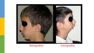 Retrognathia micrognathia
 