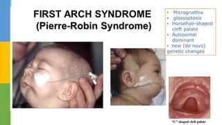 • Micrognathia
• glossoptosis
• Horsehoe-shaped
cleft palate
• Autosomal
dominant
• new (de novo)
genetic changes
 