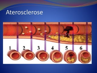 Aterosclerose
 