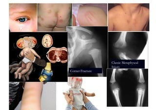 Classic Metaphyseal
                  Injury
Corner Fracture
 