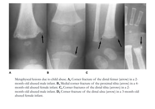 Metaphyseal lesions due to child abuse. A, Corner fracture of the distal femur (arrow) in a 2-
month-old abused male infant. B, Medial corner fracture of the proximal tibia (arrow) in a 4-
month-old abused female infant. C, Corner fractures of the distal tibia (arrows) in a 2-
month-old abused male infant. D, Corner fracture of the distal ulna (arrow) in a 3-month-old
abused female infant.
 