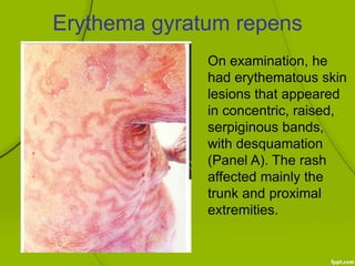 Concentric Rash Osce | PPTX
