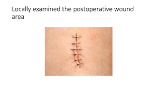 Locally examined the postoperative wound
area
 
