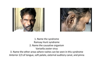 1. Name the syndrome Ramsay Hunt syndrome 2. Name the causative organism Varizella zoster virus 3. Name the other areas where rashes can be seen in this syndrome Anterior 2/3 of tongue, soft palate, external auditory canal, and pinna 