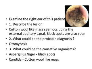 Examine the right ear of this patient 1. Describe the lesion Cotton wool like mass seen occluding the external auditory canal. Black spots are also seen 2. What could be the probable diagnosis ? Otomycosis 3. What could be the causative organisms? Aspergillus Niger - black spots Candida - Cotton wool like mass 