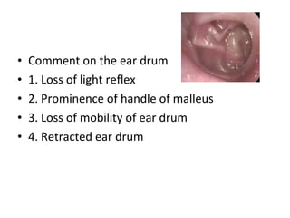 Comment on the ear drum 1. Loss of light reflex 2. Prominence of handle of malleus 3. Loss of mobility of ear drum 4. Retracted ear drum 
