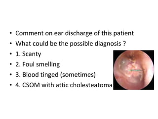 Comment on ear discharge of this patient What could be the possible diagnosis ? 1. Scanty 2. Foul smelling 3. Blood tinged (sometimes) 4. CSOM with attic cholesteatoma 