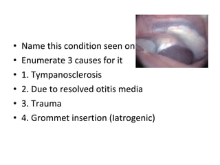 Name this condition seen on the ear drum Enumerate 3 causes for it 1. Tympanosclerosis 2. Due to resolved otitis media 3. Trauma 4. Grommet insertion (Iatrogenic) 