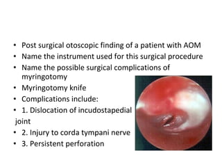 Post surgical otoscopic finding of a patient with AOM Name the instrument used for this surgical procedure Name the possible surgical complications of myringotomy Myringotomy knife Complications include: 1. Dislocation of incudostapedial joint 2. Injury to corda tympani nerve 3. Persistent perforation 