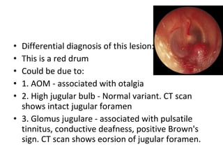 Differential diagnosis of this lesion: This is a red drum Could be due to: 1. AOM - associated with otalgia 2. High jugular bulb - Normal variant. CT scan shows intact jugular foramen 3. Glomus jugulare - associated with pulsatile tinnitus, conductive deafness, positive Brown's sign. CT scan shows eorsion of jugular foramen. 