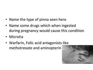 Name the type of pinna seen here Name some drugs which when ingested during pregnancy would cause this condition Microtia Warfarin, Folic acid antagonists like methotrexate and aminopterin 
