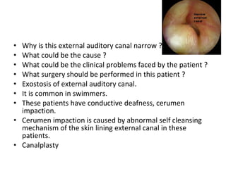 Why is this external auditory canal narrow ? What could be the cause ? What could be the clinical problems faced by the patient ? What surgery should be performed in this patient ? Exostosis of external auditory canal. It is common in swimmers. These patients have conductive deafness, cerumen impaction. Cerumen impaction is caused by abnormal self cleansing mechanism of the skin lining external canal in these patients. Canalplasty 
