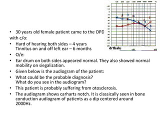 30 years old female patient came to the OPD  with c/o: Hard of hearing both sides – 4 years Tinnitus on and off left ear – 6 months O/e: Ear drum on both sides appeared normal. They also showed normal mobility on siegalization. Given below is the audiogram of the patient: What could be the probable diagnosis? What do you see in the audiogram? This patient is probably suffering from otosclerosis. The audiogram shows carharts notch. It is classically seen in bone conduction audiogram of patients as a dip centered around 2000Hz. 