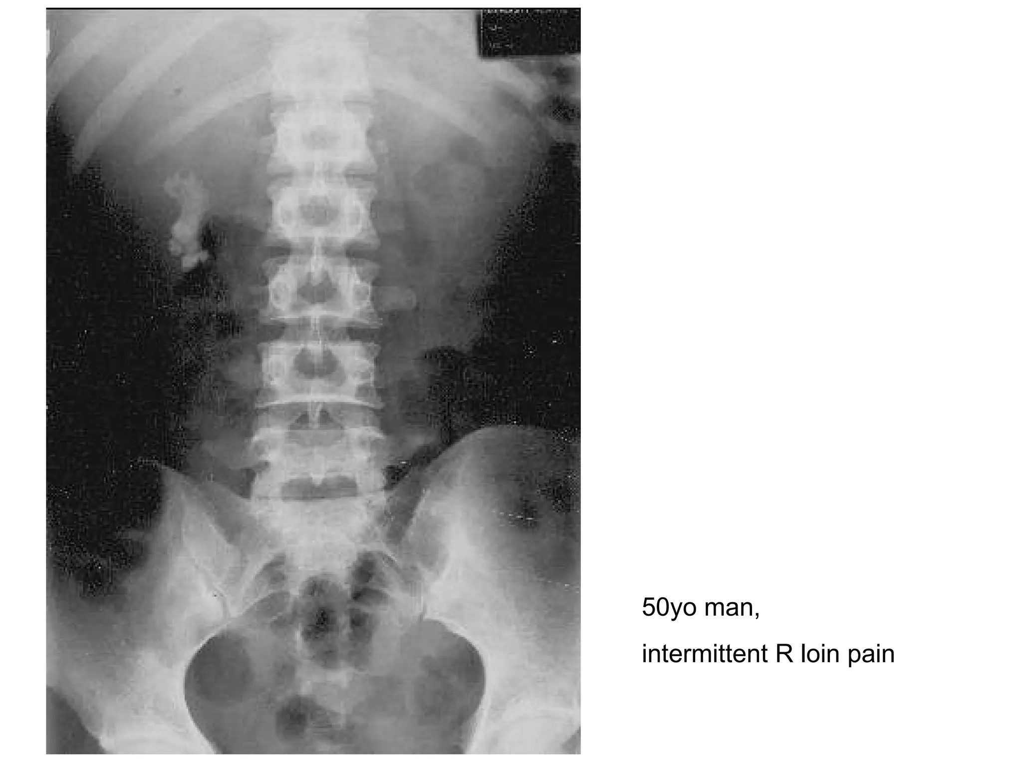 50yo man,  intermittent R loin pain 