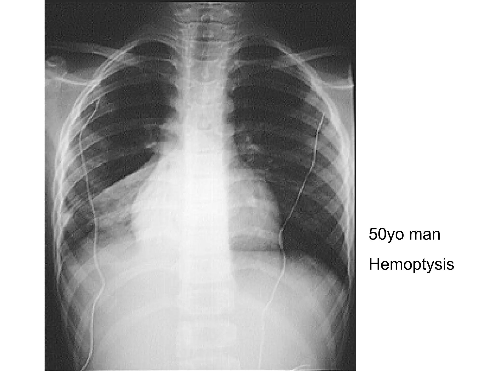 50yo man  Hemoptysis  
