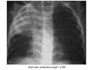 50yo man, productive cough + LOW 