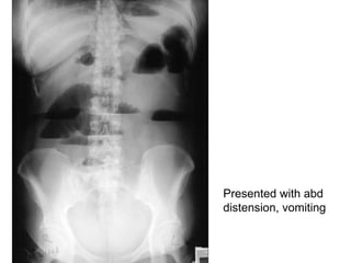Presented with abd distension, vomiting 