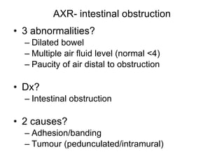 AXR- intestinal obstruction 3 abnormalities? Dilated bowel Multiple air fluid level (normal <4) Paucity of air distal to obstruction Dx? Intestinal obstruction 2 causes? Adhesion/banding Tumour (pedunculated/intramural) 