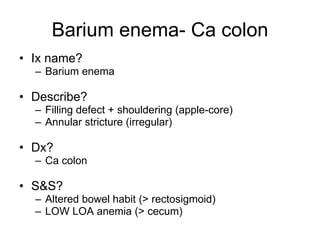 Barium enema- Ca colon Ix name? Barium enema Describe? Filling defect + shouldering (apple-core) Annular stricture (irregular) Dx? Ca colon S&S? Altered bowel habit (> rectosigmoid) LOW LOA anemia (> cecum) 