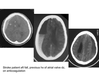 Stroke patient aft fall, previous hx of atrial valve dz, on anticoagulation 