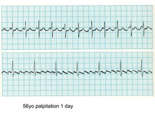 56yo palpitation 1 day 