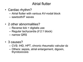 Atrial flutter Cardiac rhythm? Atrial flutter with various AV-nodal block sawtooth/F waves 2 other abnormalities? Reverse tick = digitalis use Regular tachycardia (if 2:1 block) narrow QRS  3 causes? CVS: IHD, HPT, chronic rheumatic valvular dz Others: sepsis, atrial enlargement, digoxin, thyrotoxicosis 