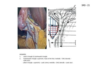 Triangle Callot OSCE-Revised PPT for University Exams.pptx