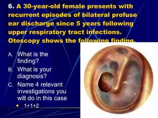 6.  A 30-year-old female presents with recurrent episodes of bilateral profuse ear discharge since 5 years following upper respiratory tract infections. Otoscopy shows the following finding. What is the finding? What is your diagnosis? Name 4 relevant investigations you will do in this case 1+1+2 