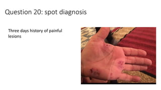 Question 20: spot diagnosis
Three days history of painful
lesions
 