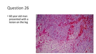 Question 26
• 60 year old man
presented with a
lesion on the leg
 