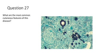 Question 27
What are the most common
cutaneous features of this
disease?
 
