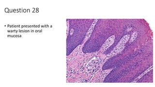 Question 28
• Patient presented with a
warty lesion in oral
mucosa
 