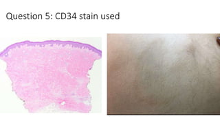 Question 5: CD34 stain used
 