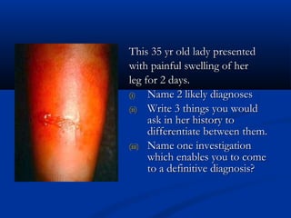 This 35 yr old lady presented
with painful swelling of her
leg for 2 days.
(i)   Name 2 likely diagnoses
(ii) Write 3 things you would
      ask in her history to
      differentiate between them.
(iii) Name one investigation
      which enables you to come
      to a definitive diagnosis?
 