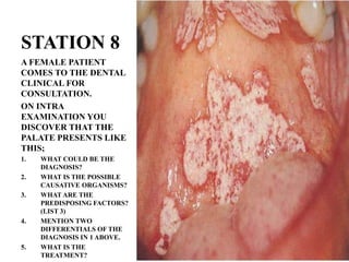 STATION 8
A FEMALE PATIENT
COMES TO THE DENTAL
CLINICAL FOR
CONSULTATION.
ON INTRA
EXAMINATION YOU
DISCOVER THAT THE
PALATE PRESENTS LIKE
THIS;
1. WHAT COULD BE THE
DIAGNOSIS?
2. WHAT IS THE POSSIBLE
CAUSATIVE ORGANISMS?
3. WHAT ARE THE
PREDISPOSING FACTORS?
(LIST 3)
4. MENTION TWO
DIFFERENTIALS OF THE
DIAGNOSIS IN 1 ABOVE.
5. WHAT IS THE
TREATMENT?
 