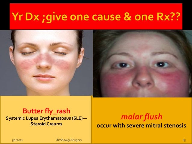 Malar Flush Mitral Stenosis Malar Flush Mitral Stenosis