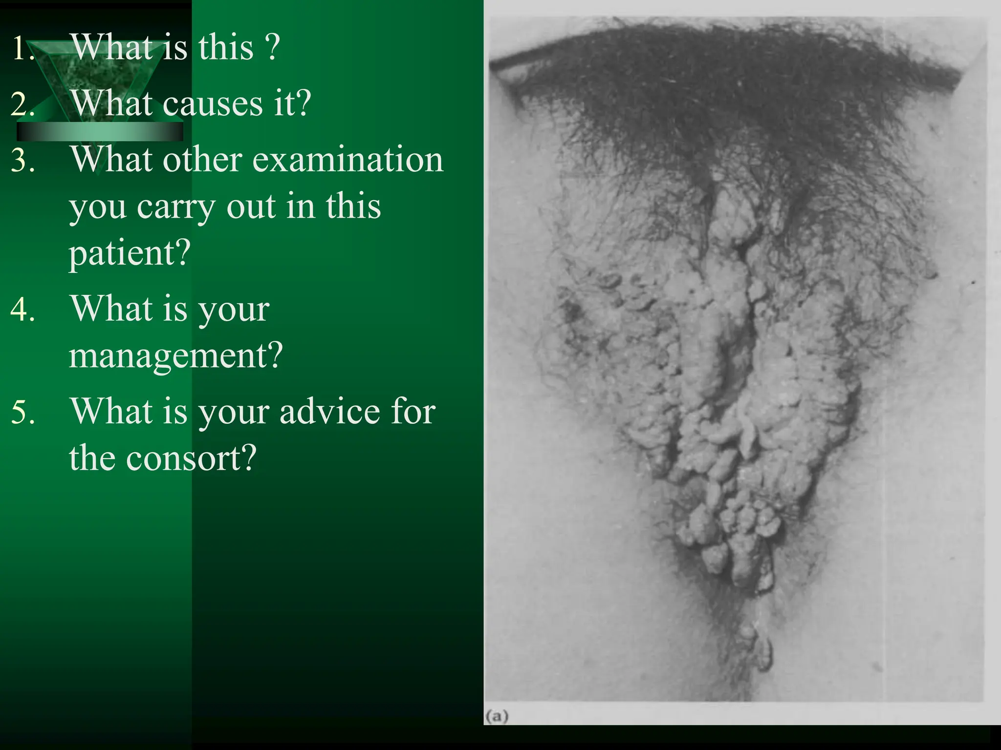 1. What is this ?
2. What causes it?
3. What other examination
you carry out in this
patient?
4. What is your
management?
5. What is your advice for
the consort?
 