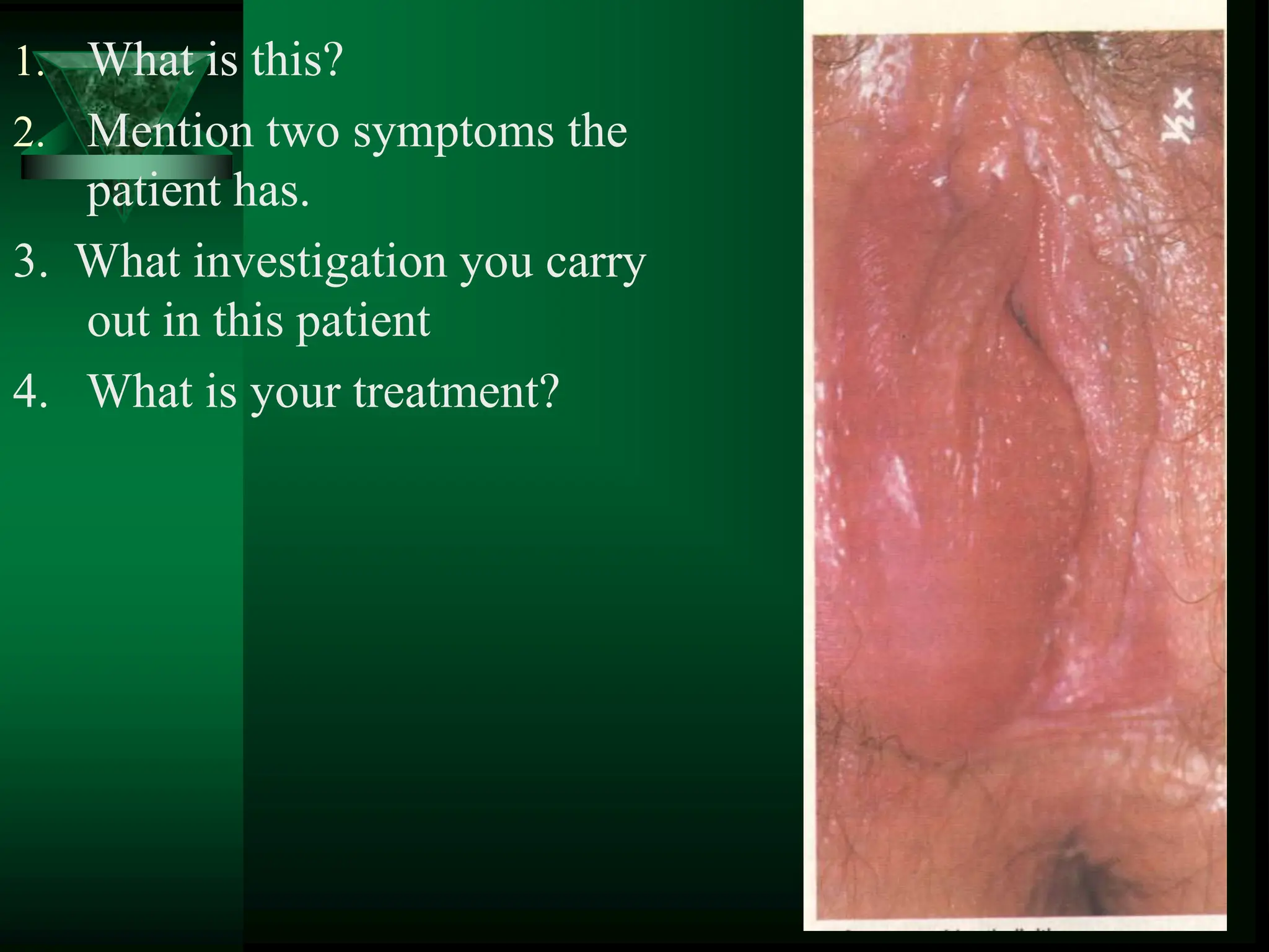 1. What is this?
2. Mention two symptoms the
patient has.
3. What investigation you carry
out in this patient
4. What is your treatment?
 