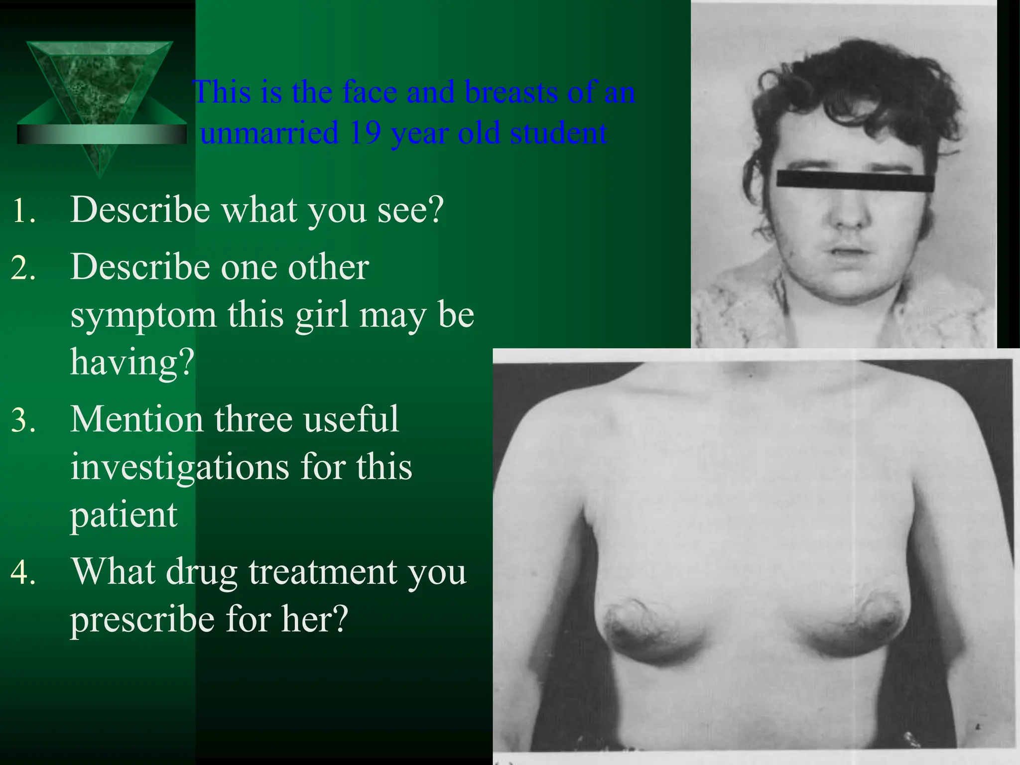 This is the face and breasts of an
unmarried 19 year old student
1. Describe what you see?
2. Describe one other
symptom this girl may be
having?
3. Mention three useful
investigations for this
patient
4. What drug treatment you
prescribe for her?
 