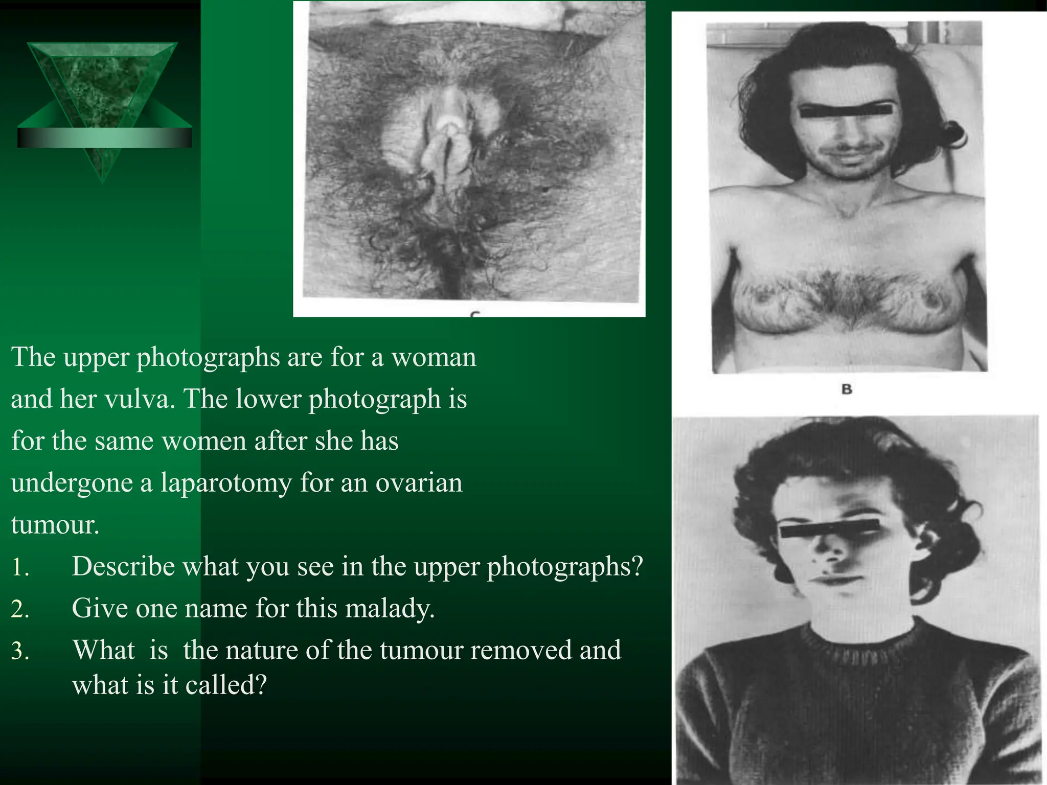The upper photographs are for a woman
and her vulva. The lower photograph is
for the same women after she has
undergone a laparotomy for an ovarian
tumour.
1. Describe what you see in the upper photographs?
2. Give one name for this malady.
3. What is the nature of the tumour removed and
what is it called?
 