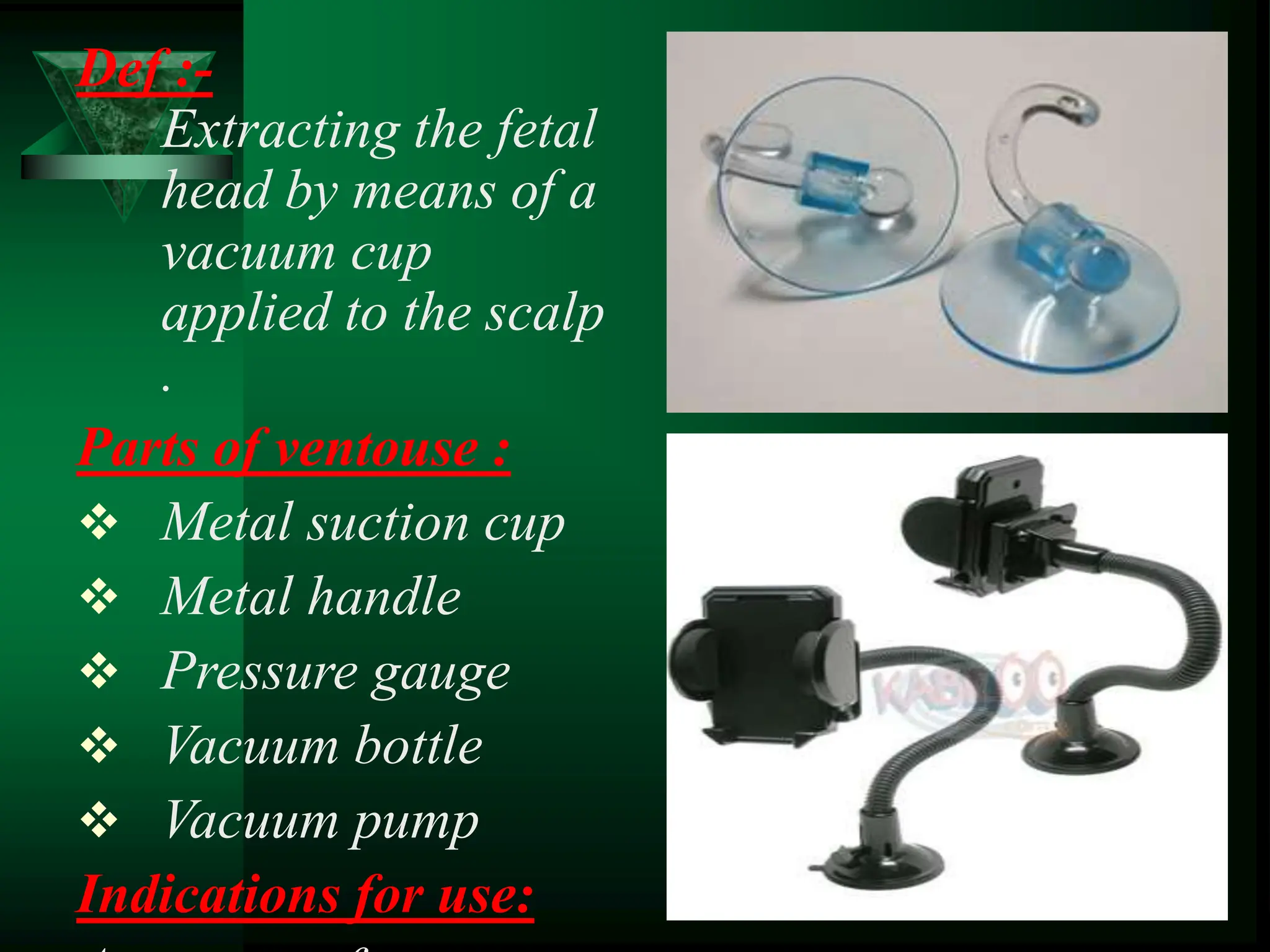 Def :-
Extracting the fetal
head by means of a
vacuum cup
applied to the scalp
.
Parts of ventouse :
 Metal suction cup
 Metal handle
 Pressure gauge
 Vacuum bottle
 Vacuum pump
Indications for use:
 