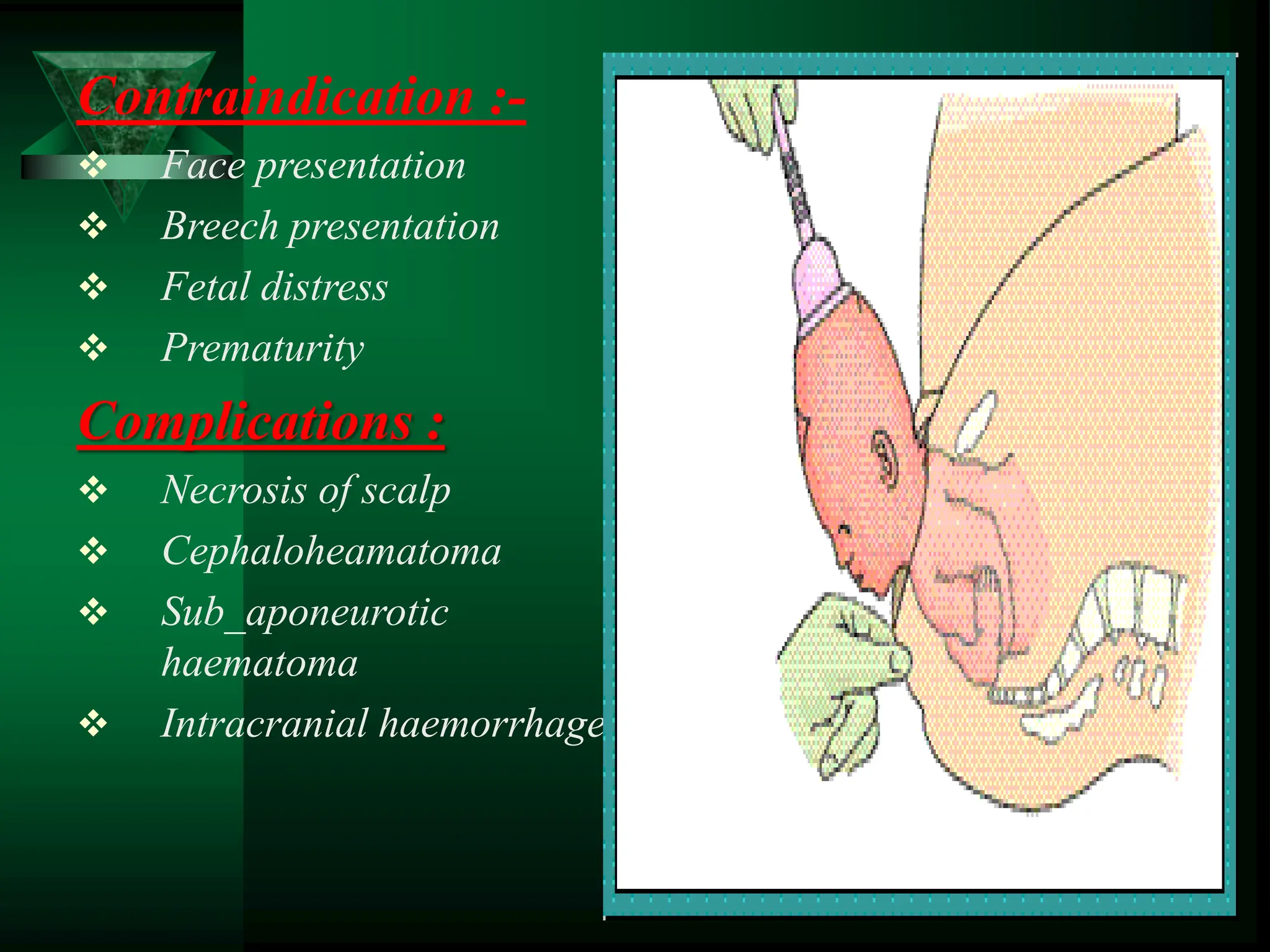 Contraindication :-
 Face presentation
 Breech presentation
 Fetal distress
 Prematurity
Complications :
 Necrosis of scalp
 Cephaloheamatoma
 Sub_aponeurotic
haematoma
 Intracranial haemorrhage
 