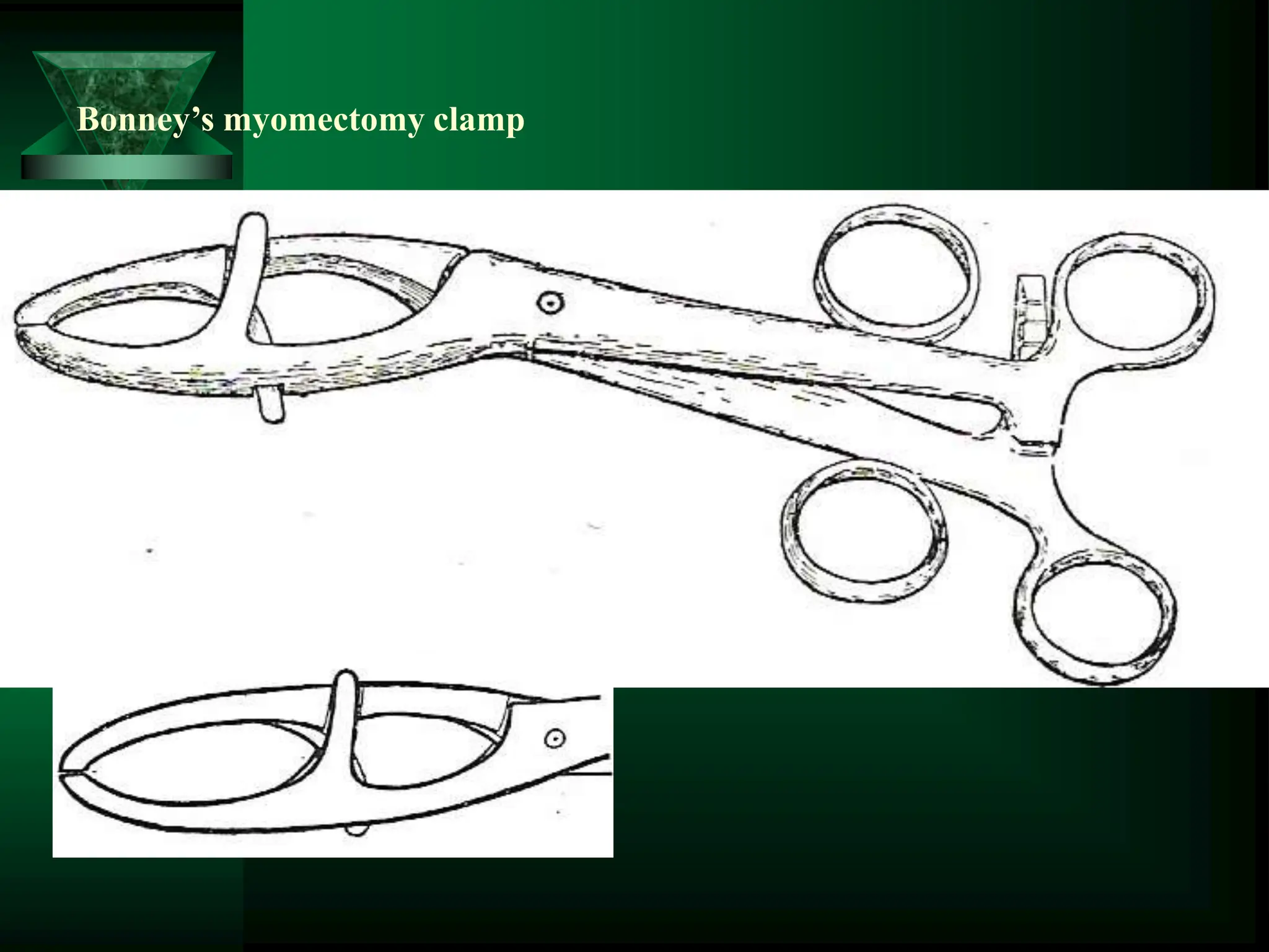 Bonney’s myomectomy clamp
 