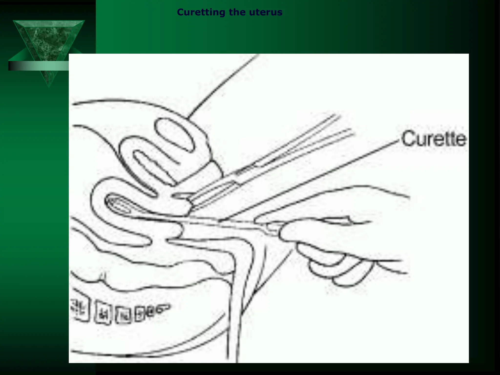 Curetting the uterus
 